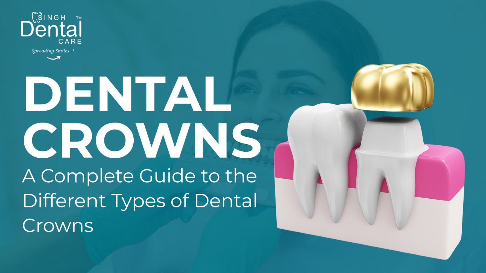 Dental Crowns