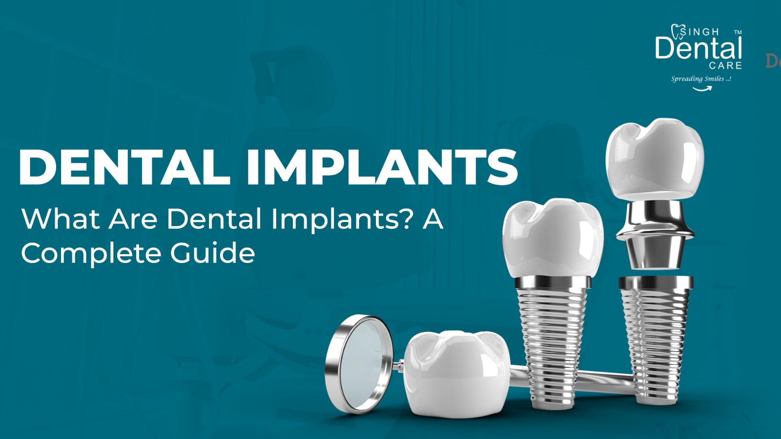 What Are Dental Implants