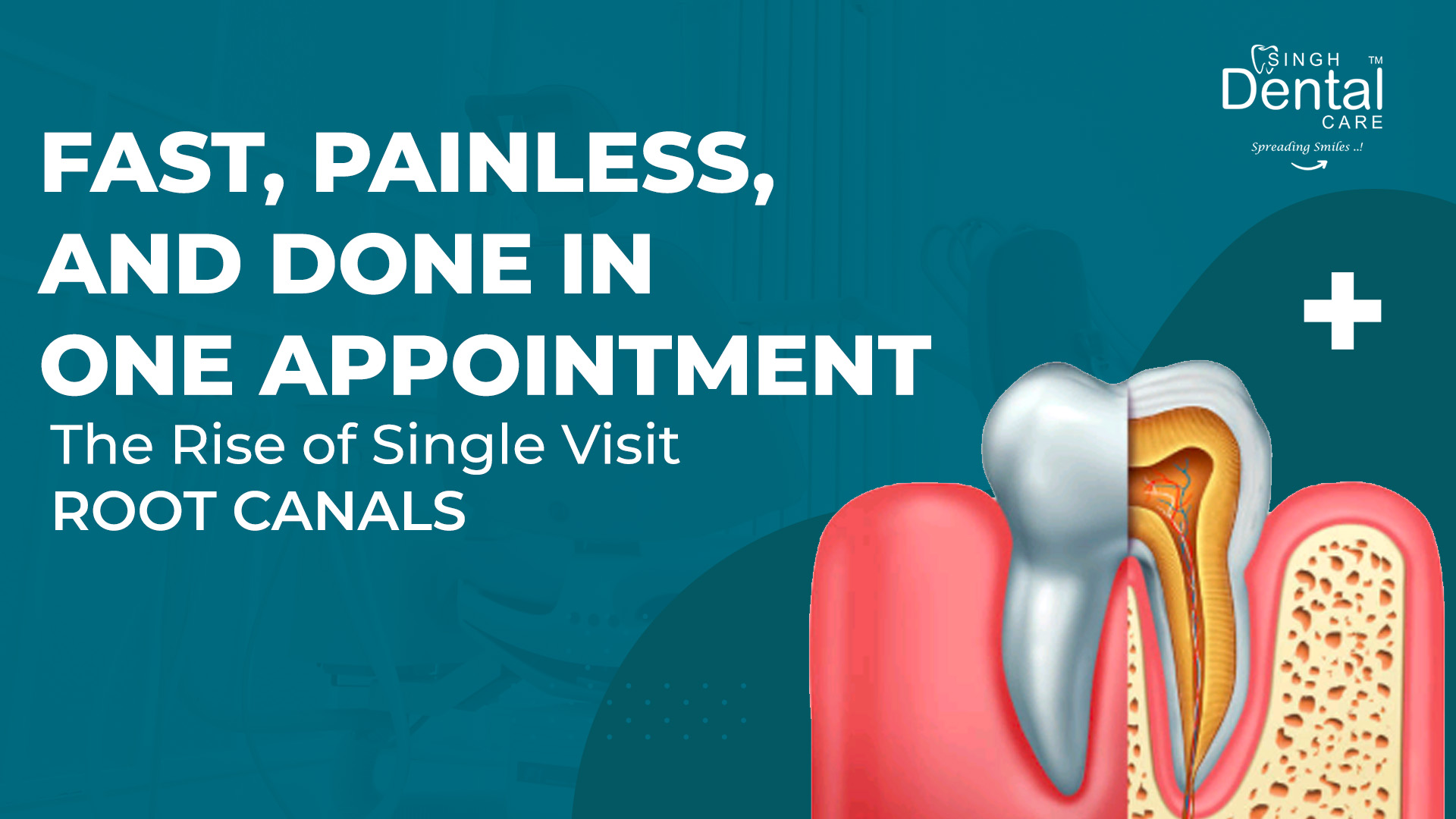 Single visit root canal