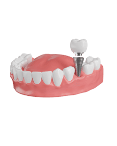 Implant